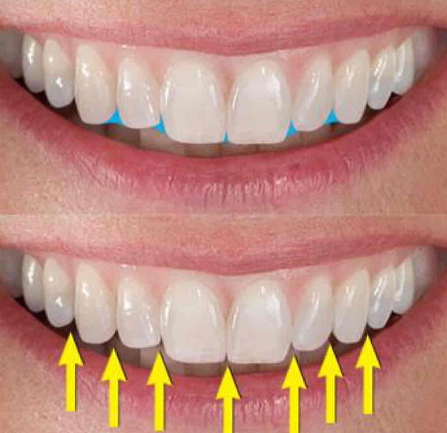<p>v shaped space between the curved proximal surfaces of adjacent anterior teeth (incisal to proximal contact)</p><ul><li><p>shape of the embrasure is determined by the morphology of the teeth </p></li></ul>