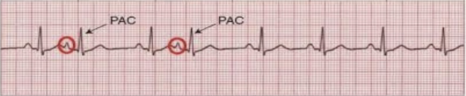 <p>arrive early in the cardiac cycle → longer PR; have different morphologies than normal waves</p>