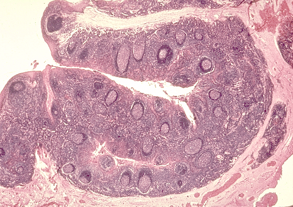 <p><strong>Tonsils </strong></p><p>Crypt and nodules w/ germinal centers observed</p>