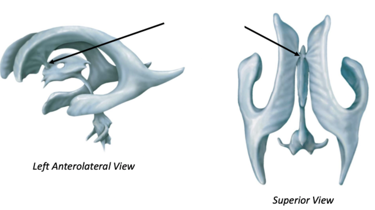 <p>Lateral Ventricles</p>