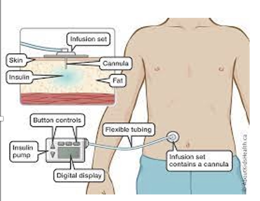 <p>*may have to adjust during exercise</p><p><span><span>-For </span><em><u><span>T1DM using insulin pumps</span></u></em><span>, insulin delivery during exercise can be markedly reduced by decreasing the basal rate or disconnecting the pump for short durations, depending on the intensity and duration of exercise.</span></span></p><p><span style="font-family: &quot;Courier New&quot;;"><span>o</span></span><span><span>Reducing basal insulin delivery rates for up to 12 hours postexercise may be necessary to avoid later-onset hypoglycemia.</span></span></p><p><span><span>-Continuous glucose monitors may be useful in detecting patterns in blood glucose across multiple days and evaluating the effects of exercise.</span></span></p>