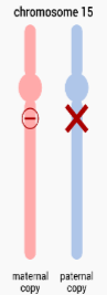<p>chromosomal deletion on the paternal copy of chromosome 15</p><ul><li><p>symptoms: hypogonadism, hyperphagia, obesity, intellectual disabilities, etc.</p></li></ul><p></p>