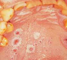 <p>occurs on the <span style="color: red;">posterior hard palate </span>and <span style="color: red;">anterior soft palate</span> of smokers, especially<span style="color: red;"> pipe smokers</span></p><ul><li><p><strong>cause:</strong></p><ul><li><p>caused by <span style="color: red;">heat on the mucosa</span> </p></li><li><p><span style="color: red;">not </span>actually by the nicotine itself!</p></li></ul></li><li><p><strong>treatment:</strong></p><ul><li><p><span>encourage the patient to </span><span style="color: red;"><span>STOP SMOKING</span></span></p></li></ul></li></ul><p></p>