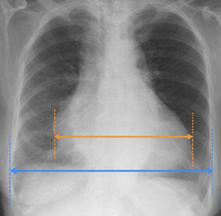 <p>What pathology is seen on this x-ray?</p>
