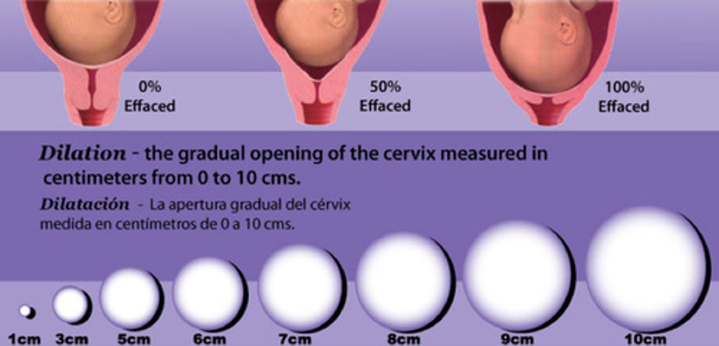 <p>Effacement: shortening of the cervix (%)</p><p>Dilation: diameter of the os (in cm)</p>