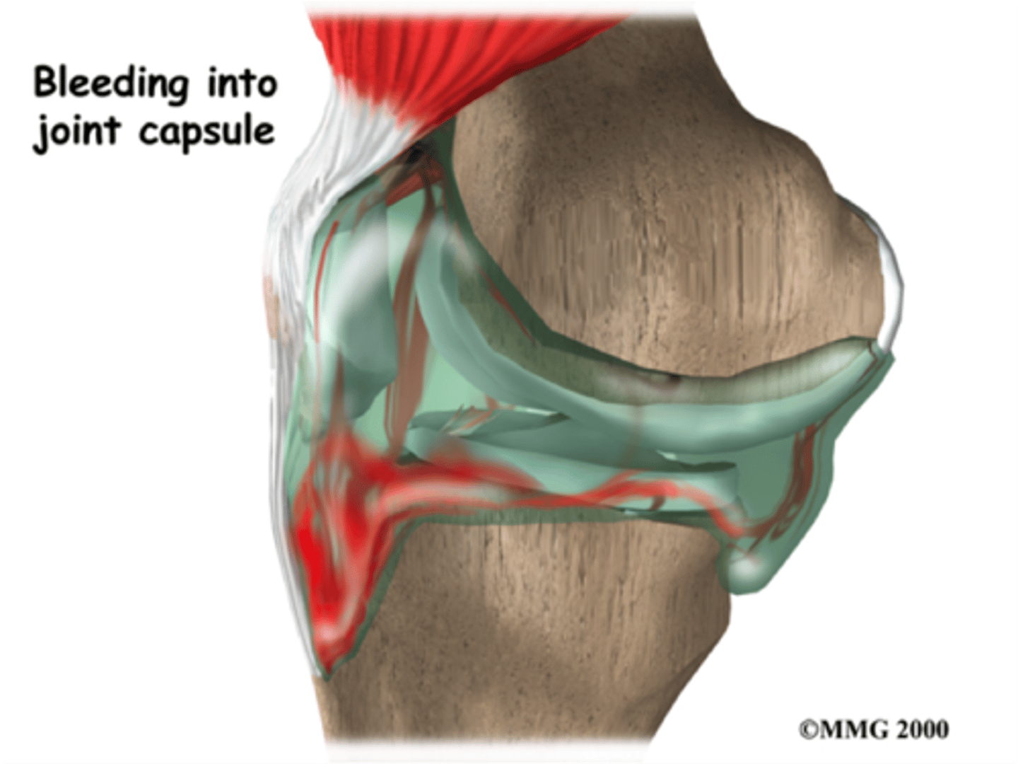 <p>Spontaneous bleeding occurs in the hip, knee, and ankle joints when a child begins to walk</p>