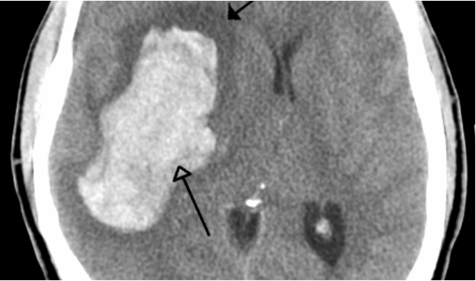 <p>What stroke has the following appearance on a head CT?</p><ul><li><p>bright/white &amp; seen earlier </p></li></ul><p></p>