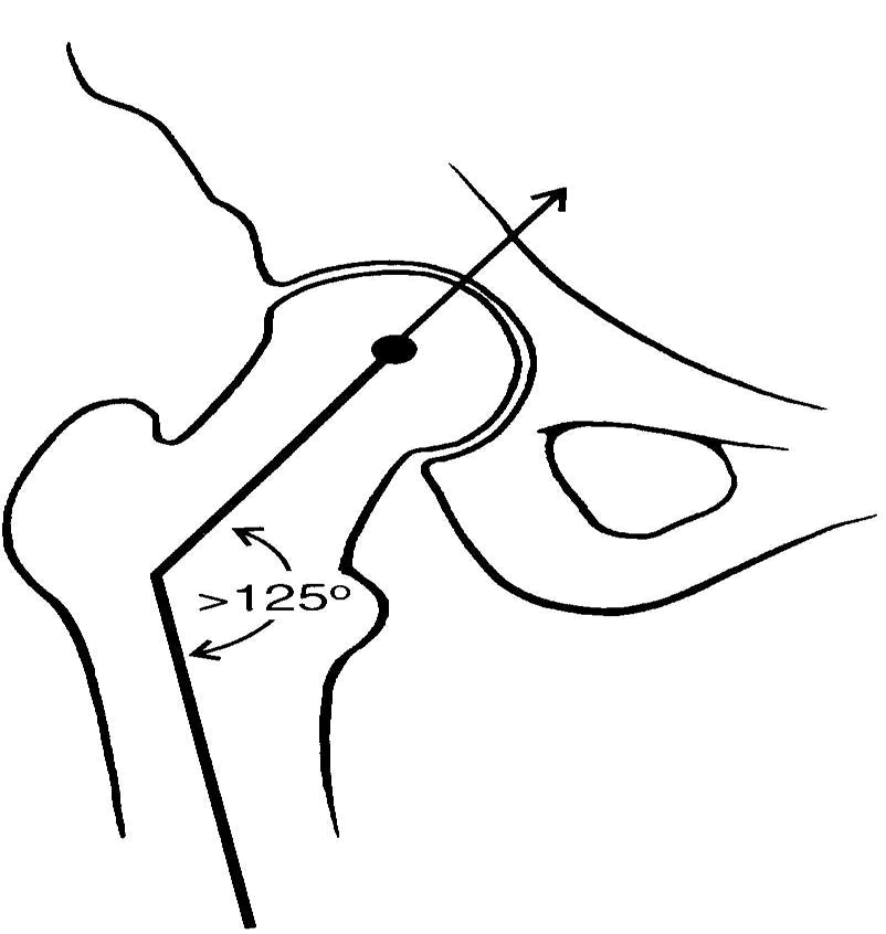 <p>angle of femur and pelvis articulation</p>