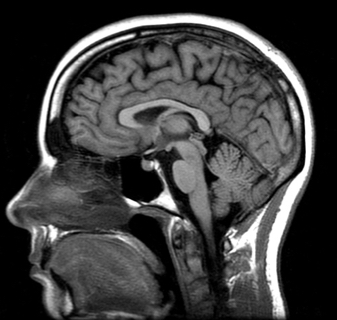 <p>Magnetic field that gives a detailed picture of the brains soft tissues</p>