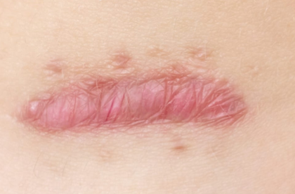 <p>Common Skin Variation</p><ul><li><p>Remnant of the wound</p></li><li><p>Common for patient who undergoes surgery</p></li></ul><p></p>