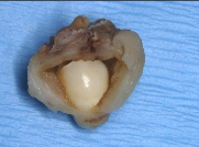 <p>What are some clinical features of a dentigerous cyst?</p>