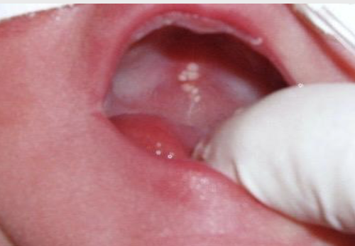 <p><span style="color: #000000">Occur along the median palatal raphe due to epithelial entrapment by palatal fusion</span></p>