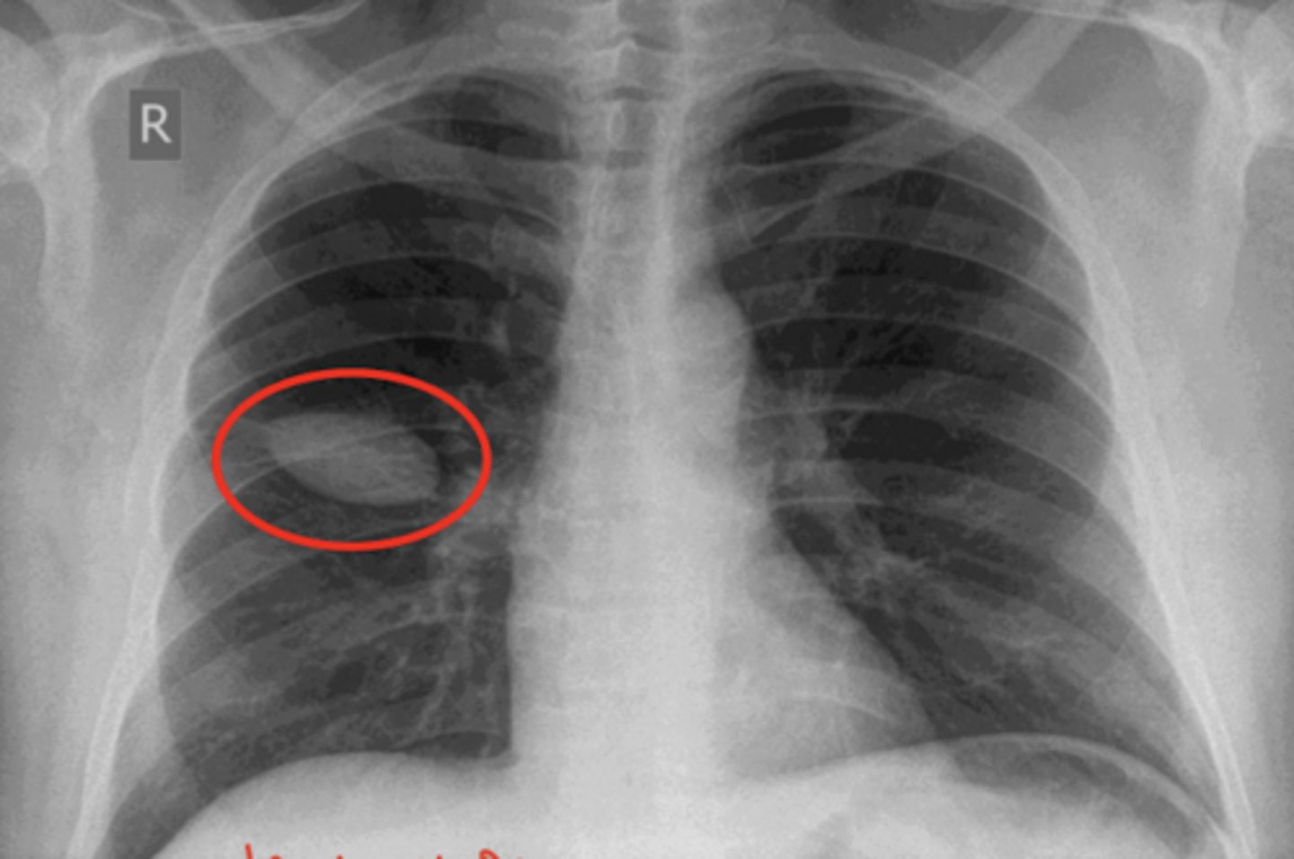 <p>Name this appearance that is associated with Pulmonary Edema. How is this treated?</p>