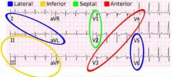 <p>blue- lateral </p><ul><li><p>I, aVL</p></li><li><p>V5, V6</p></li></ul><p>yellow - inferior</p><ul><li><p>II, III, aVF</p></li></ul><p>Green - septal</p><ul><li><p>V1, V2</p></li></ul><p>Red- Anterior</p><ul><li><p>V3, V4</p></li></ul><p></p>