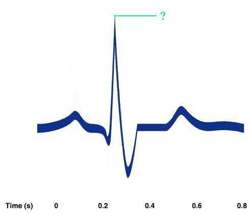 <p><span><span>Identify the indicated portion of the EKG.</span></span></p>