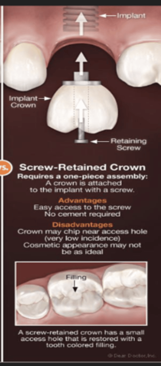 <p>crown and abutment are fixed together, the screw goes all the way thru the crown, abutment, and body</p><p>usually posterior teeth</p>
