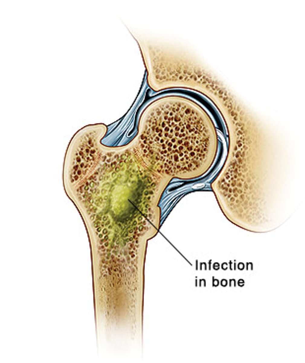 <p>Malignancy in wound</p><p>Untreated osteomyelitis</p><p>Eschar/slough in wound bed over 25% of wound area</p><p>Exposed vessels or organs</p>