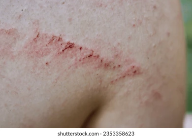 <p>A lesion from scratching or excessive rubbing of the skin</p>
