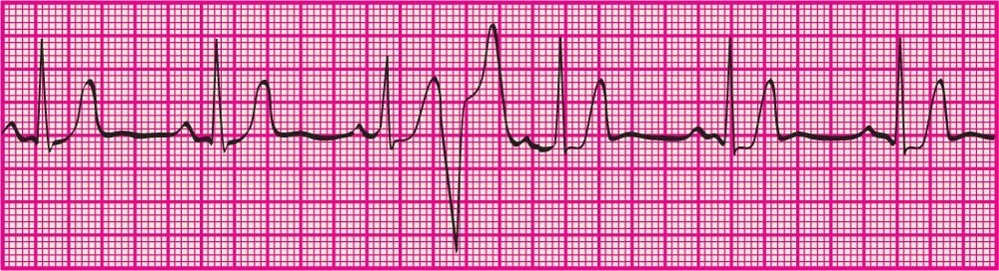 <p>PVC that occurs during the normal R-R Interval without interrupting the underlying rhythm</p>
