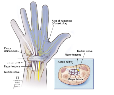 <p>Damage to the Median Nerve </p>