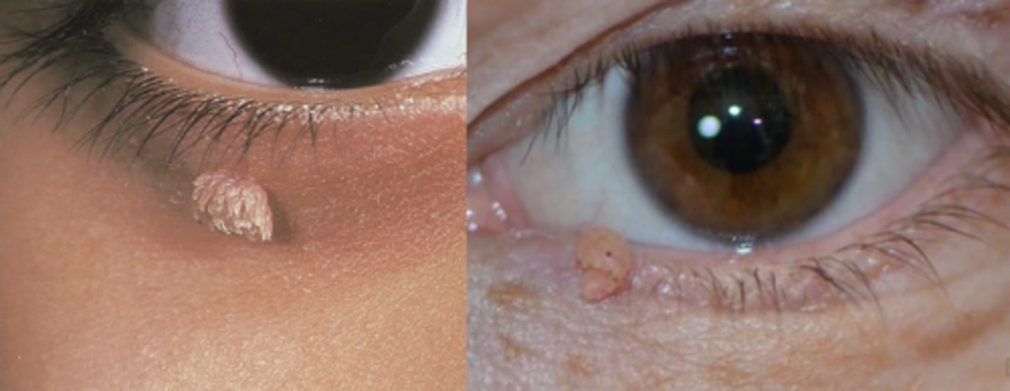 <p>epidermal tissue wart, either plane (flat) or finger-like projections (filiform/digitate) = can increase in pigment and keratinization over time</p>