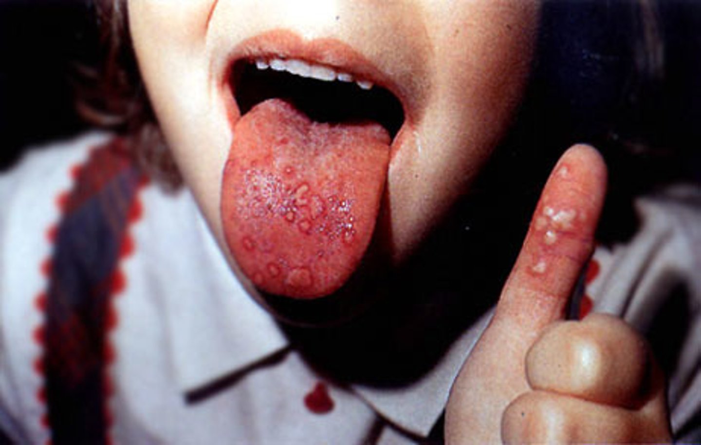 <p>lesions in mouth with fever, common in children</p>
