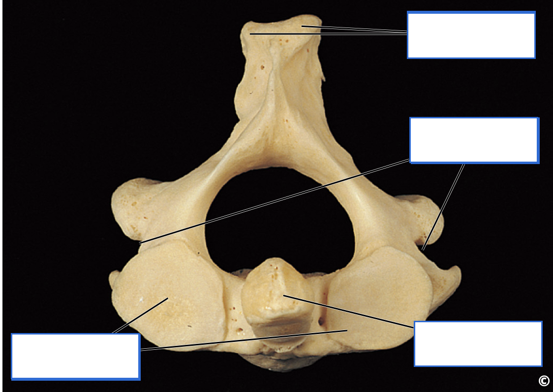 <p>Identify the bone features of the Axis (C2)</p>