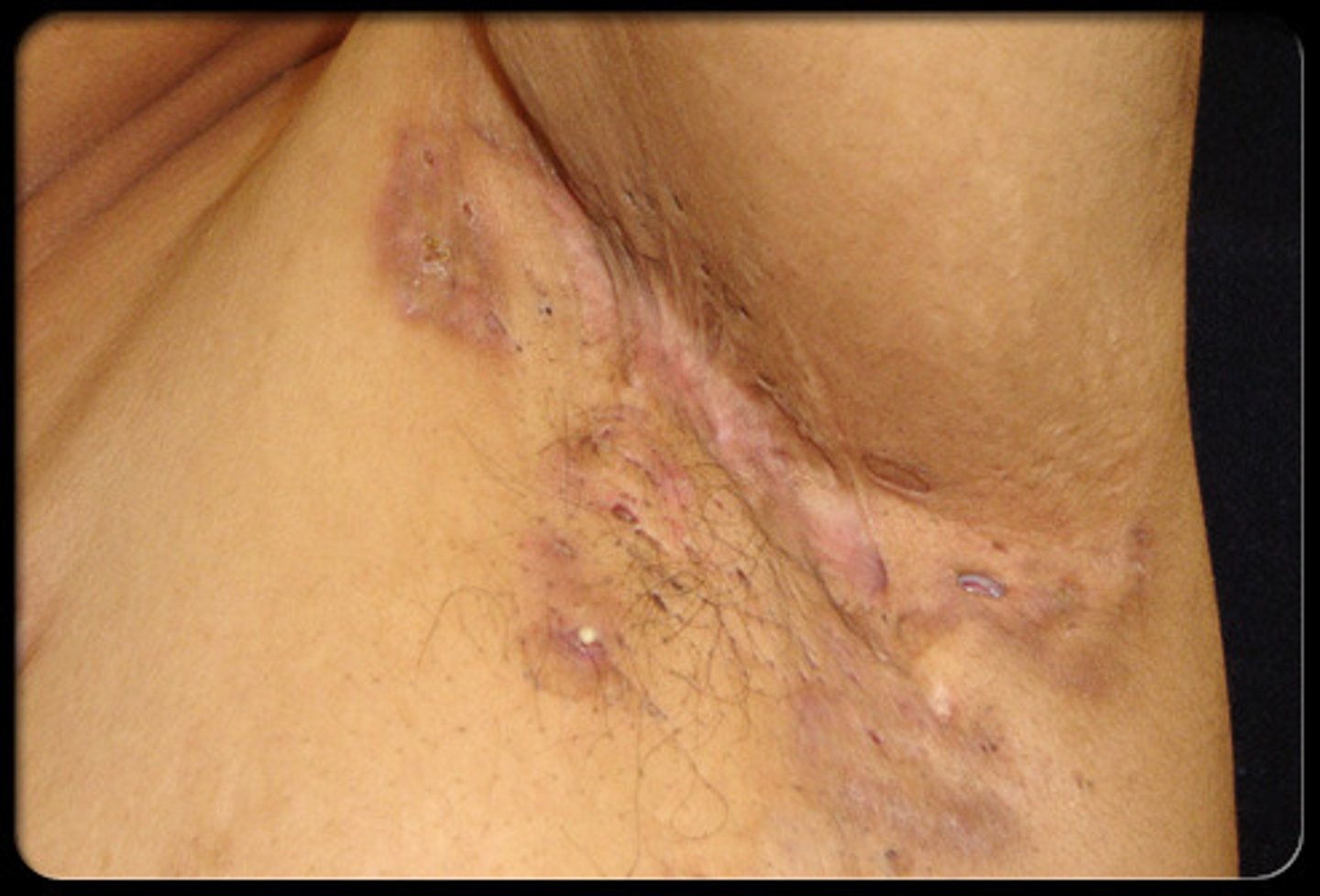 <p>Inflammation of the sweat glands</p>