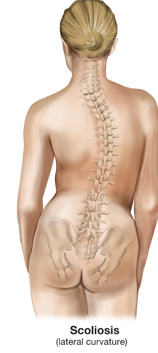 Describe scoliosis.