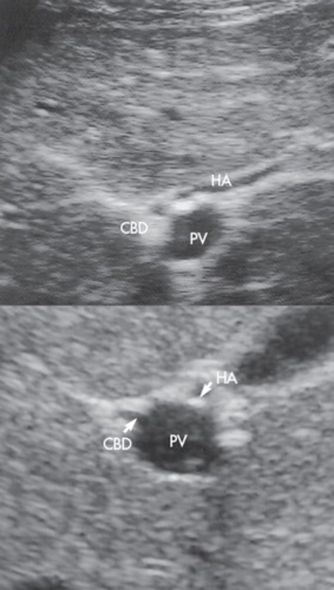 <p>Right branch of celiac trunk</p>