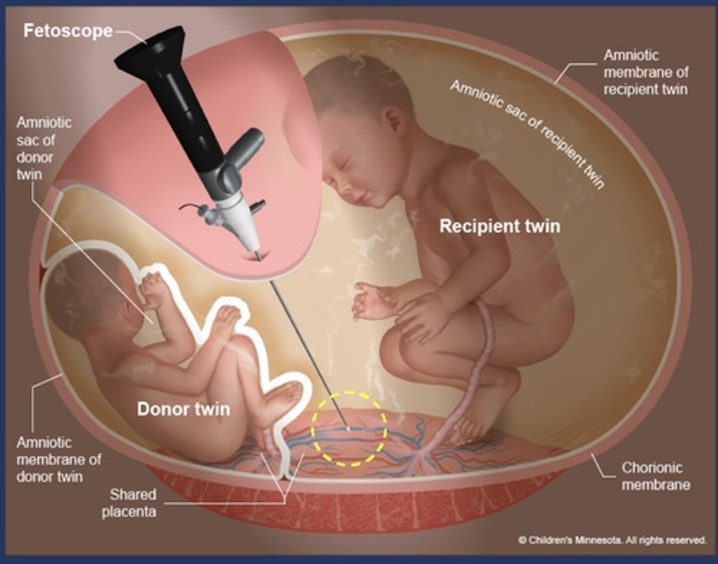<p>Laser used to coagulate anastomosing placental vessels</p><p>75% survival of 1 twin</p><p>60% survival of both twins</p>