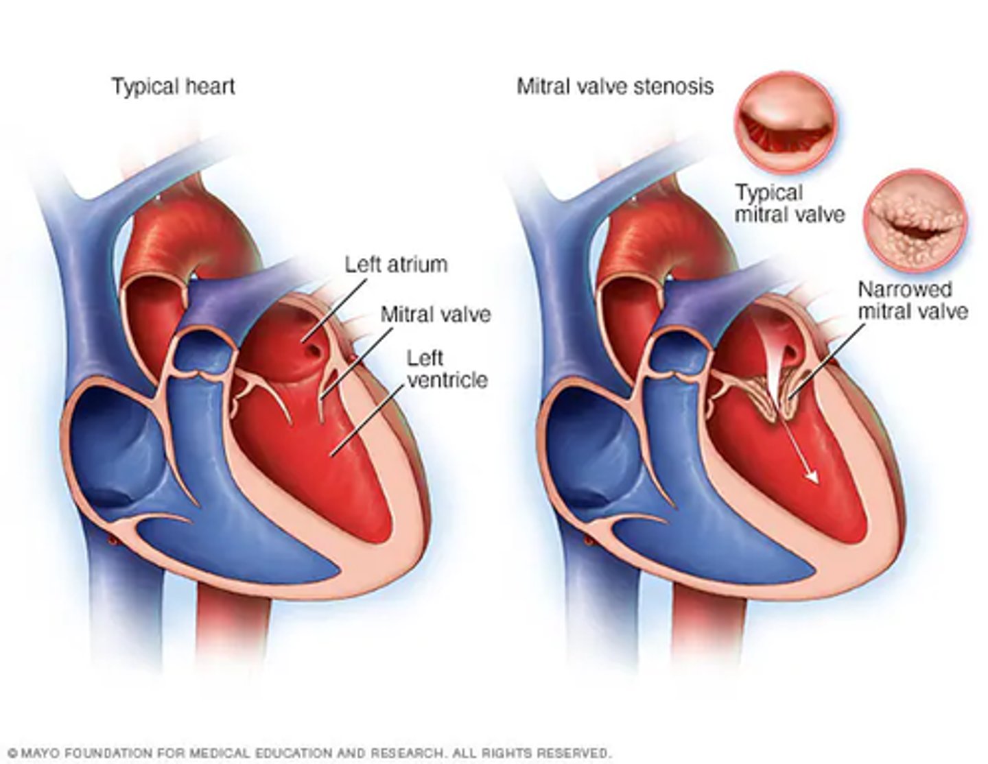 <p>mitral stenosis</p><p>mitral</p>