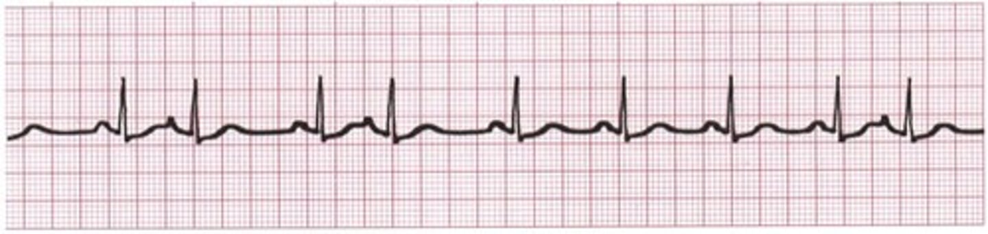 <p>Beat is early, P wave is absent or changes, QRS is normal</p><p>A slight pause follows the PAC (compensatory pause for absolute refractory)</p><p>isolated (1 PAC) or couplet (every other PAC)</p>
