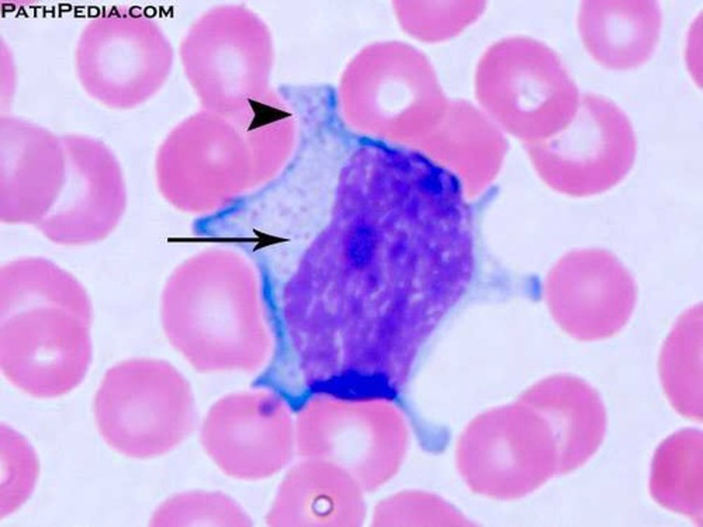 <p>- Pleomorphic</p><p>- Easily indented by surrounding cells</p><p>- Irregular nucleus</p><p>- Occasional nucleoli</p><p>- Coarse to fine &amp; dispersed chromatin</p><p>- Can have vacuoles or azurophilic granules</p>