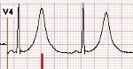 <p>hyperacute T waves</p>