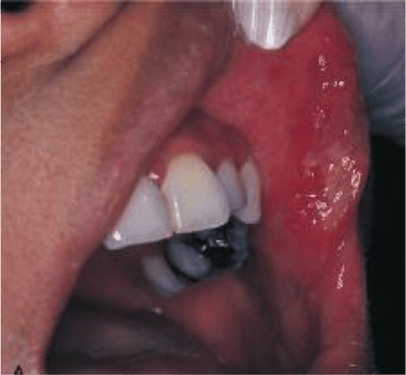 <p>Major aphthous ulcers</p>