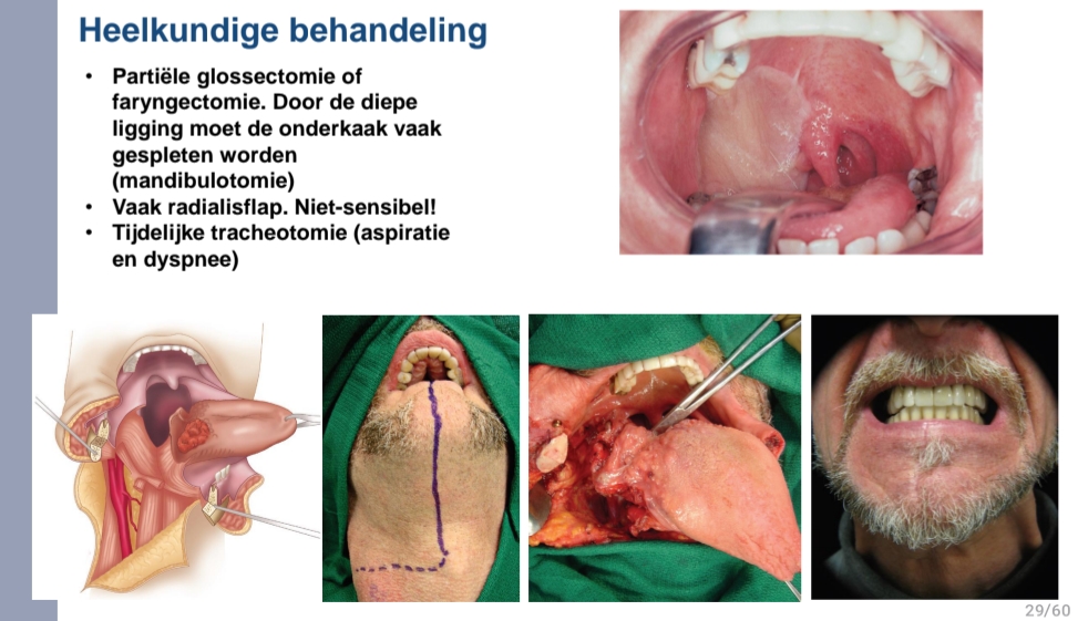 <p>Partiële glossectomie of  faryngectomie. </p><p>Door de diepe  ligging moet de onderkaak vaak <br>gespleten worden <br>(mandibulotomie)<br>• Vaak radialisflap. Niet-sensibel!<br>• Tijdelijke tracheotomie (aspiratie <br>en dyspnee) → want slikreflex werkt niet goed meer</p>