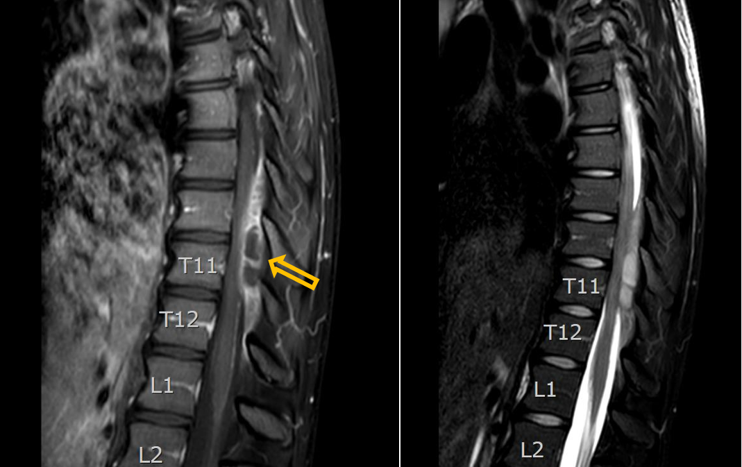 <p>Patient history: days with progrediatingsevere lower back pain, fever, paraparesis, urinary retention disturbance in an immunocompromised patient </p><p>Modality: left – T1W fatsat postcontrast MRI after iv. gadolinium administration; right – T2W fatsat MRI (sagittal view) </p><p>Region: thoracic spine </p><p>Radiologic sign: epidural enhancing mass at the level of Th 9-12th vertebras (yellow arrow), no signal loss on fatsat image; non-enhancing fluid signal intensity inside of the mass </p><p>Diagnosis: epidural abscess</p>