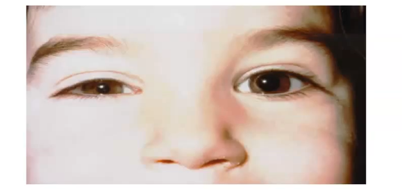 <p>horners syndrome- loss of input from the sympathetic ganglia </p><p>unopposed sphincter action  </p><p>smaller pupil </p><p>dilator muscle paralysed </p><p>any age </p><p>associated with poor dilation, ptosis and facial anhydrosis</p><p>check up routinely&nbsp;</p><p> </p>