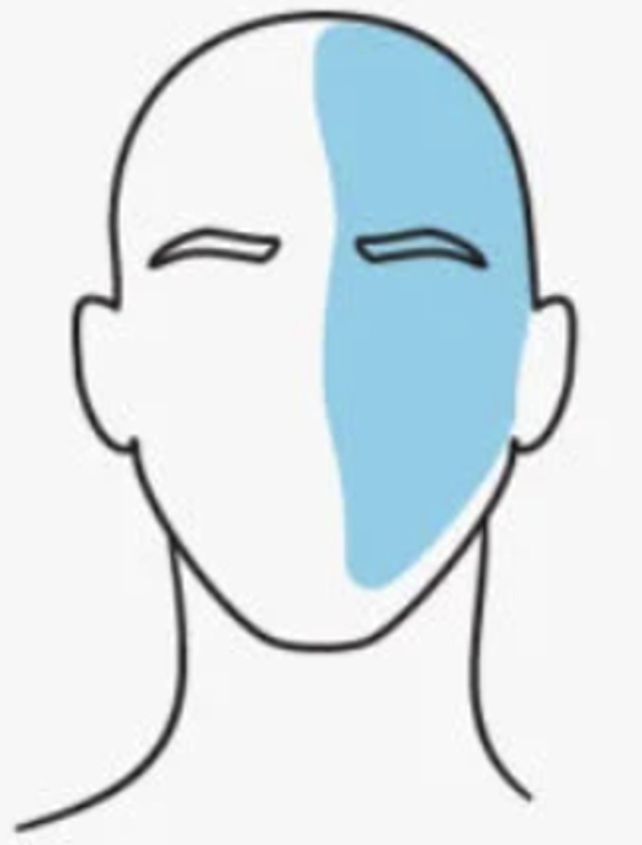 <p>•Moderate to severe head pain</p><p>•Unilateral pain pulsating quality of pain</p><p>•Aggravation of pain by routine physical activity</p>