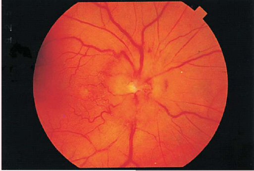 <p><span>GLAUCOMA</span></p>