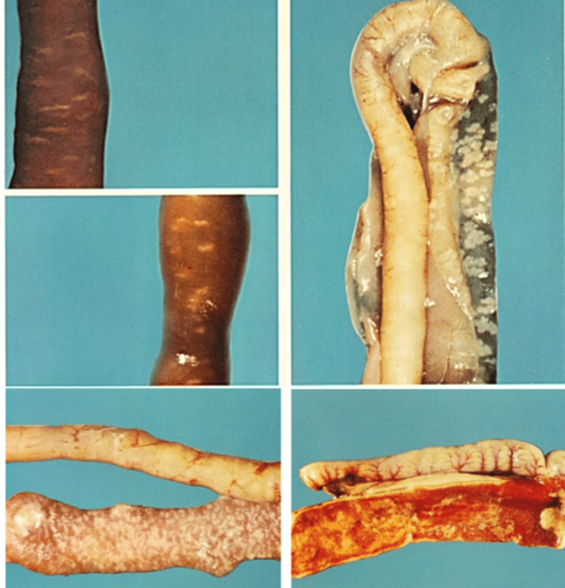 <p>Eimeria acervulina</p><p>Locates in the duodenum</p><p>Scattered, white plaque-like lesions containing developing oocysts =&gt; in heavier infections lesions coalesce;</p><p>Intestinal wall is thickened;</p><p>Heavy infections =&gt; mucosa is bright red.</p>