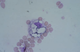 Figure 12: Macrophage with RBC remnants