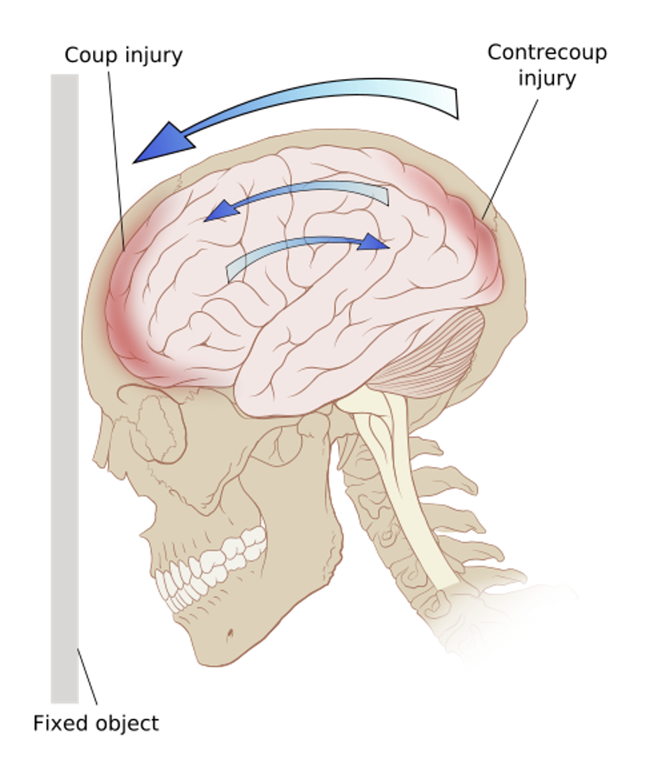 <p>What is a contrecoup injury?</p>