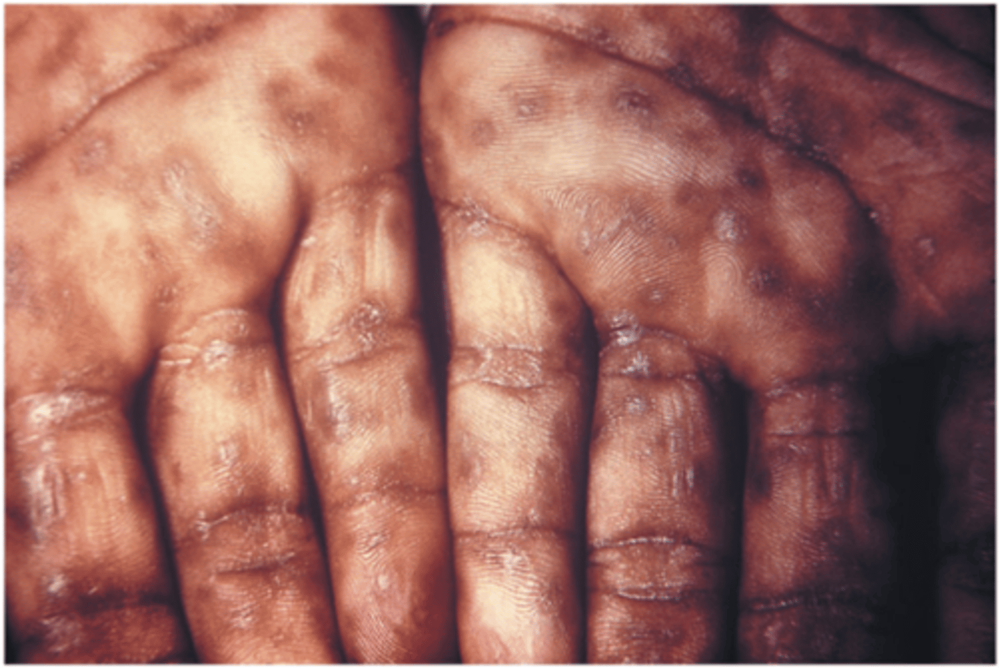 <p>secondary syphilis</p>