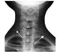 <p>extra rib arising from 7th cervical vertebrae (only 1 in 500)</p><p>causes a form of thoracic outlet syndrome (compression of lower trunk of brachial plexus or subclavian artery between cervical rib and scalene muscles</p>