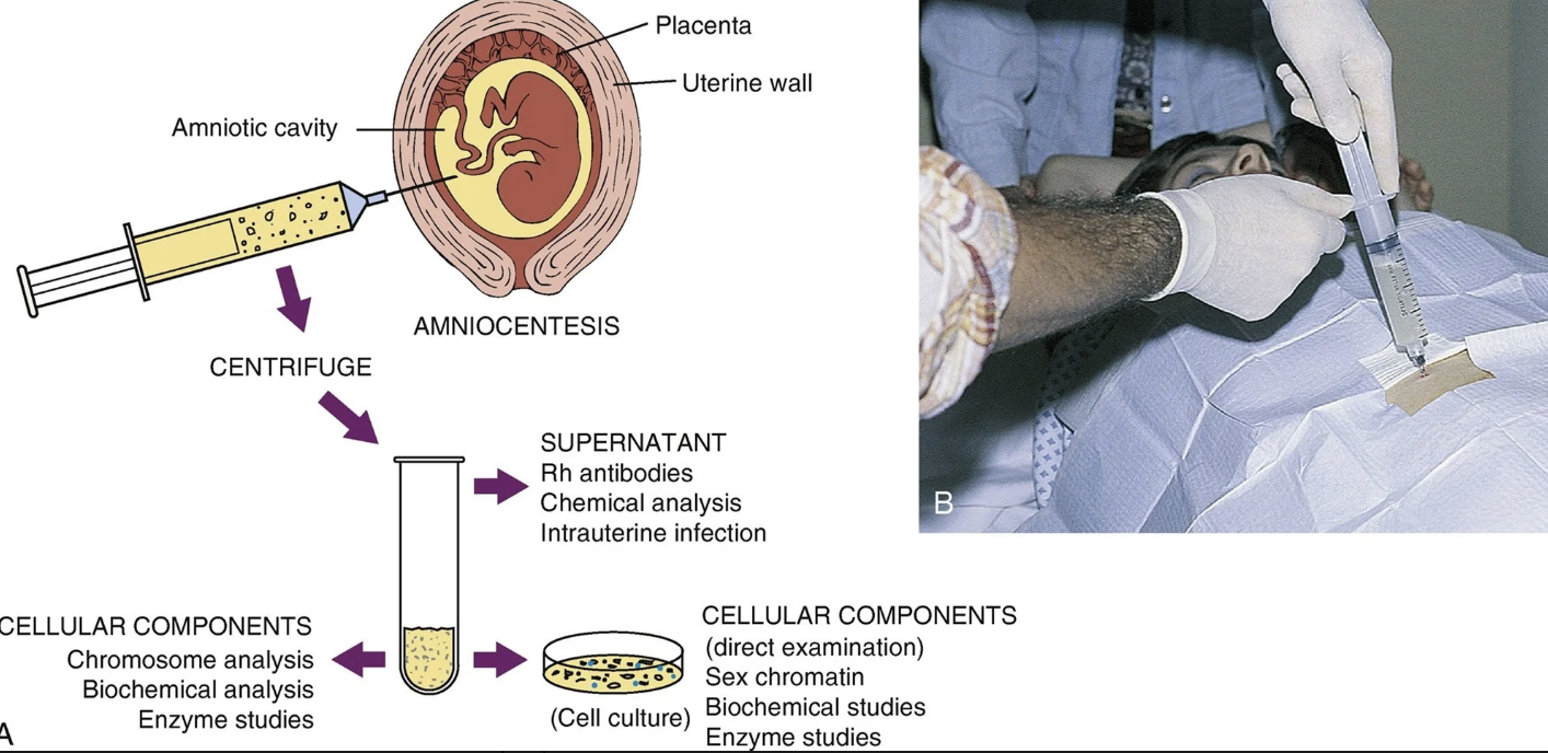 <ul><li><p>usually <strong>at or after 15 weeks</strong> to obtain amniotic fluid which contains fetal cells</p></li><li><p>a <u>needle is inserted transabdominally into the uterus</u> and amniotic fluid is withdrawn into a syringe.</p></li><li><p><strong>should be avoided performing before 13-14 weeks</strong>→ higher risk for pregnancy loss, amniotic fluid leakage, and fetal talipes equinovarus (clubfoot)</p></li><li><p><u>Indications-</u> prenatal diagnosis of genetic disorders or congenital anomalies (neural tube defects [NTDs] in particular), assessment of pulmonary maturity, and (very rarely) diagnosis of fetal hemolytic disease.</p></li><li><p>Because of the possibility of fetomaternal hemorrhage, administering <strong>Rh0(D) immune globuli</strong>n to the woman who is <u>Rh negative</u> is standard practice after an amniocentesis.</p></li></ul><p></p>