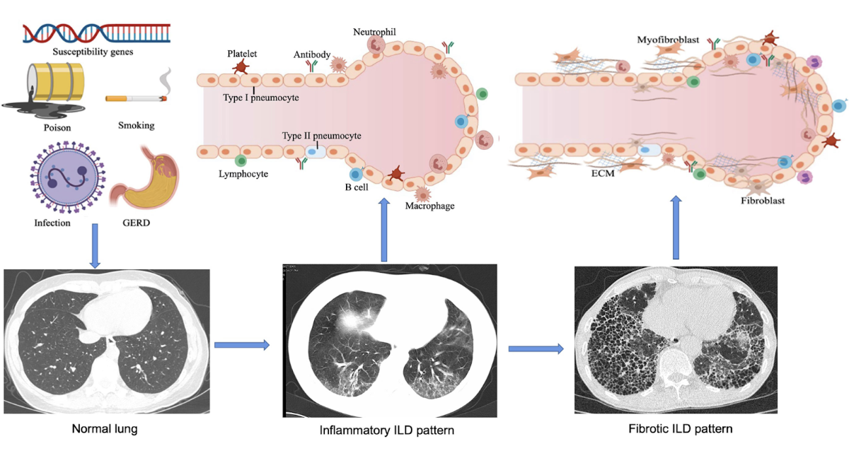 <p>Det är en grupp av sjukdomar som påverkar lungans <strong>interstitium</strong>, alltså utrymmet mellan alveolerna och kapillärerna. Det beror på en inflammation som leder till tillganade fibos. Fibrosen ger en minskad diffusionkapacitet samtidigt som man får en<strong> restriktiv lungfunktionsnedsättning</strong>. </p>