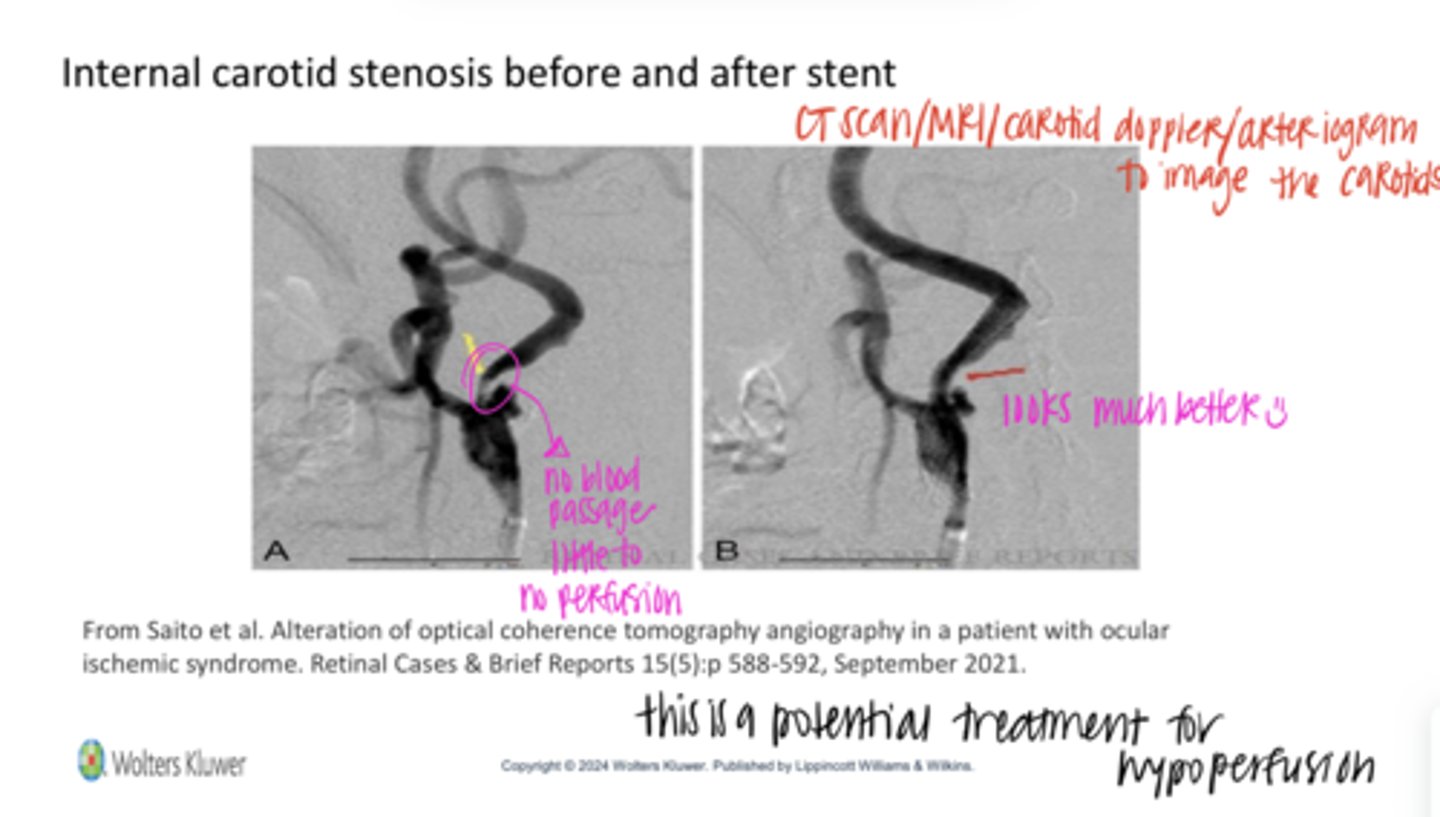 <p>Internal Carotid Stenosis Before and After a Stent (Pic)</p>