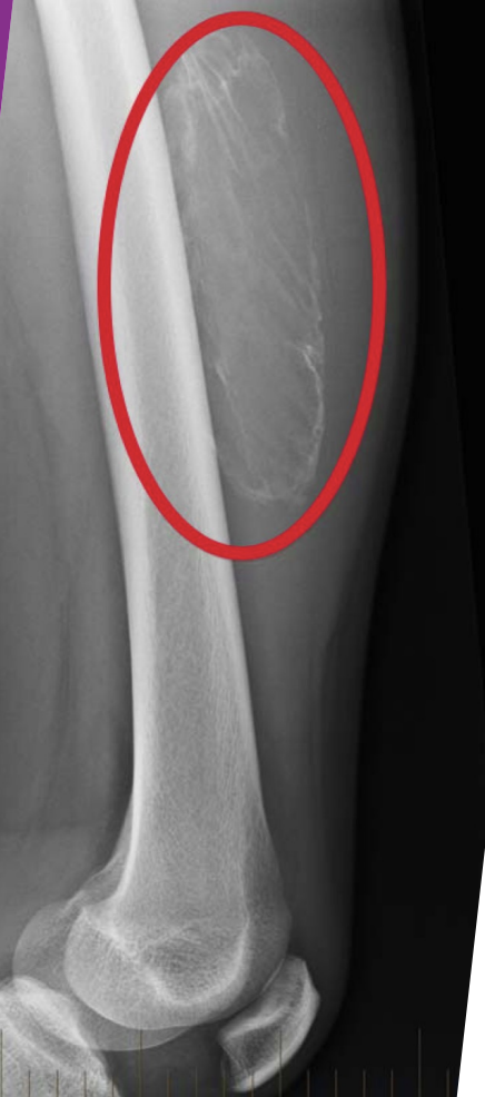 <p>Myositis Ossificans </p>